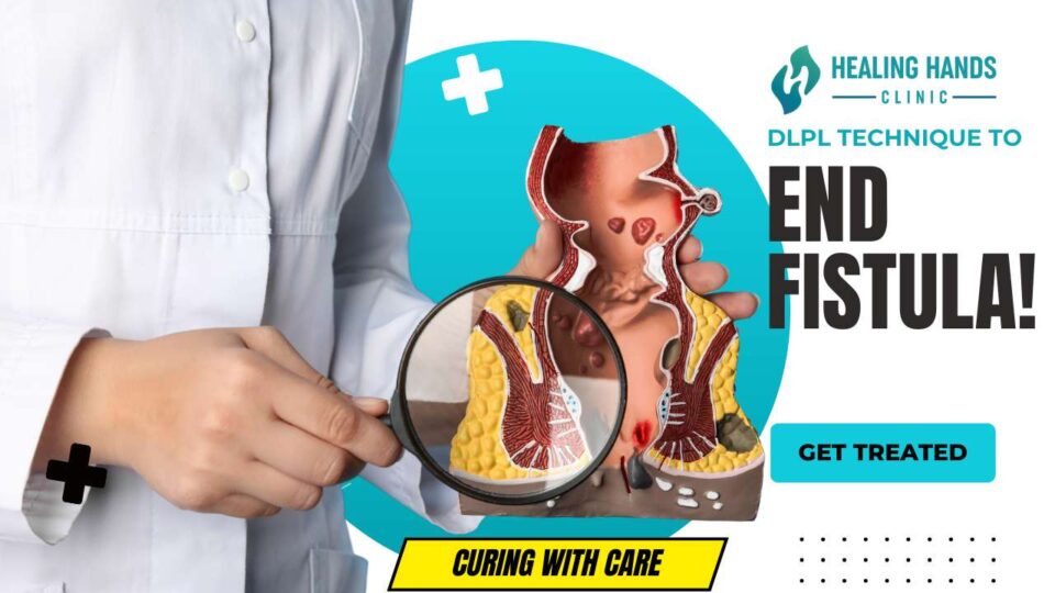 How to Cure Fistula Permanently?- DLPL Fistula Treatment 